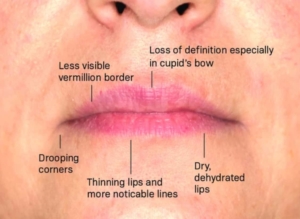 lip-aging