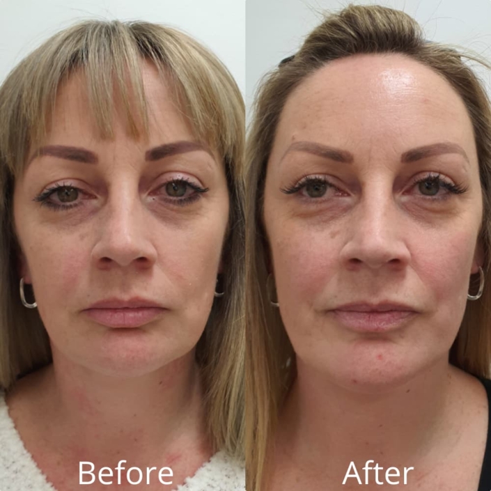 before and after pdo thread lift