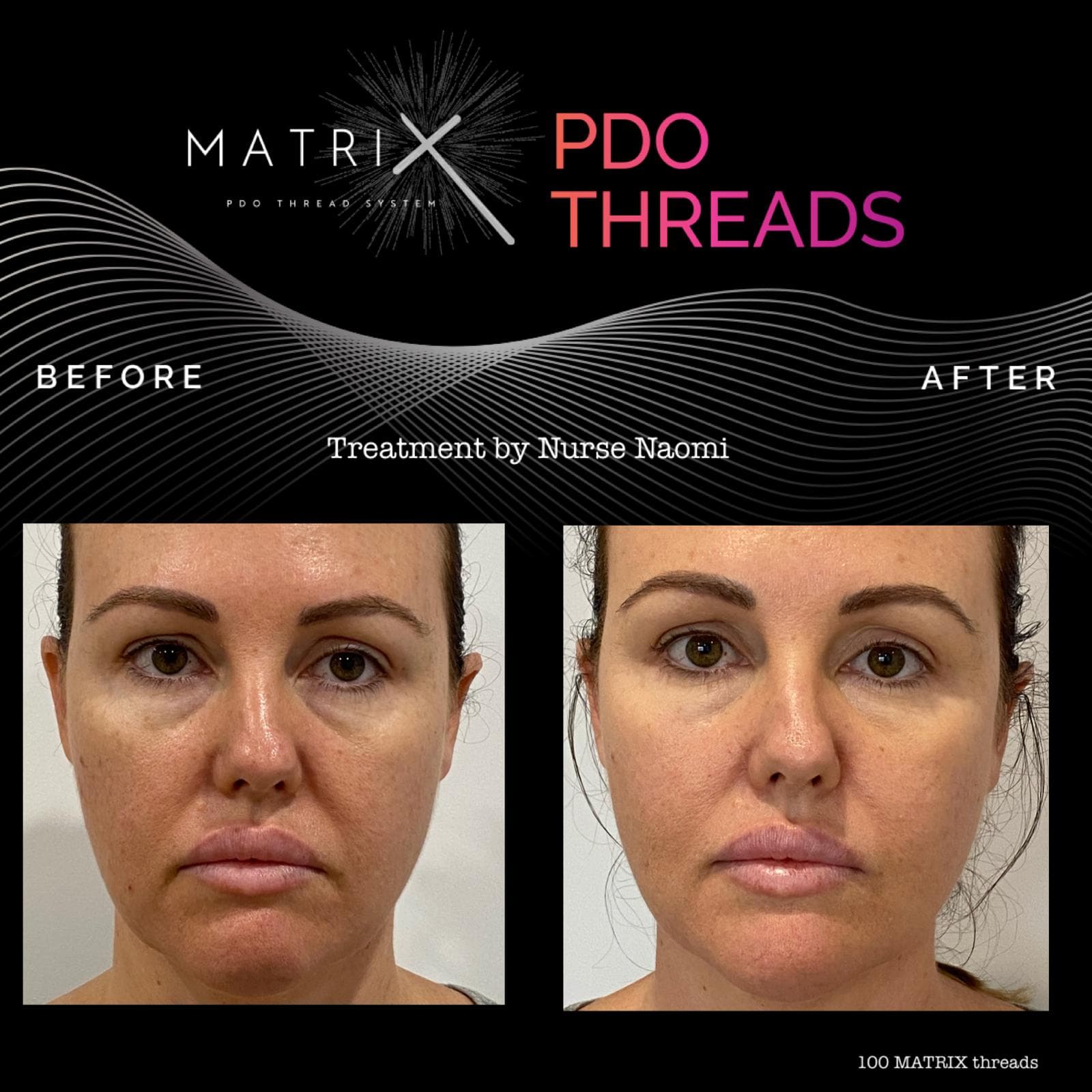 before and after pdo thread lift eyes